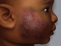 Image result for Eczema Black People
