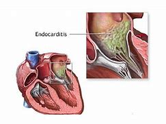 Image result for endocarditis