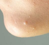 Image result for Inflamed Molluscum Contagiosum