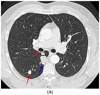Image result for Lung Nodules Lower Lobe CT Scan