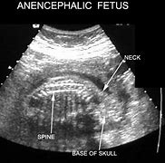 Image result for Anencephaly Sonograms