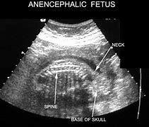 Image result for Sonography of Anencephaly