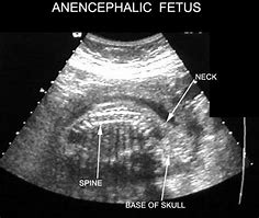 Image result for Anencephaly Ultrasound Images 3D