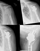 Image result for Comminuted Proximal Humerus Fracture
