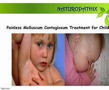 Image result for Molluscum Treatment Cream
