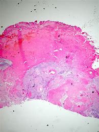 Image result for Squamous Cell Carcinoma Lung Cancer