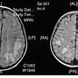 Image result for encefalomielitos