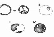 Image result for Ovarian Cyst Types