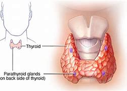 Image result for hypoparathyroidism