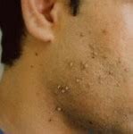 Image result for Types of Warts On Face