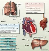 Image result for Carcinoid Heart Disease