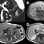 Image result for MRI MRCP Pancreas