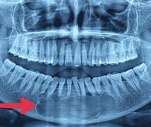 Image result for Periapical Abscess On OPG