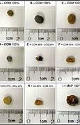 Image result for 4Mm Kidney Stone Size Chart