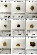 Image result for 4Mm Stone in Kidney