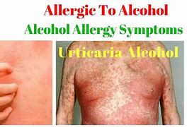 Image result for Alcohol Histamine Reaction