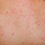 Image result for Body Lice Bites WW1
