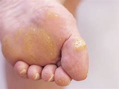 Image result for Warts On Top of Feet