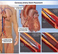 Image result for ICA Stent