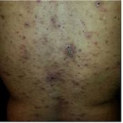 Image result for Folliculitis Black Skin