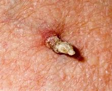 Image result for Cutaneous Horn Wart