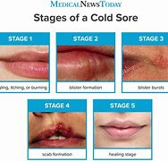 Image result for Stress Cold Sore