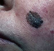 Image result for Melanoma Skin Cancer On Face
