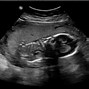 Image result for Sirenomelia Fetal