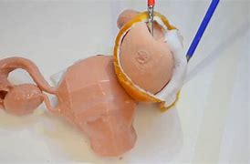 Image result for Ovarian Cyst Removal Surgery