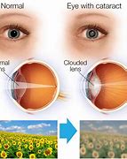 Image result for Blurry Vision with Cataracts