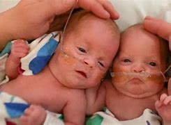 Image result for Premature Babies 24 Weeks