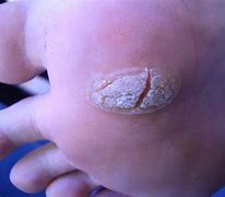 Image result for Common Wart Removal