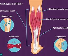 Image result for Sudden Pain in Calf Muscle