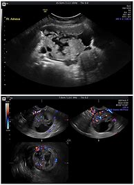 Image result for Cystadenocarcinoma Ovary Ultrasound