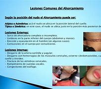 Image result for axorchamiento