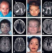 Image result for Lissencephaly Wheelchair