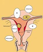 Image result for Uterus with Fibroids