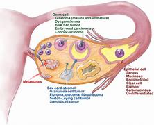 Image result for Most Common Benign Ovarian Tumor