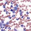 Image result for Philadelphia Chromosome Leukemia