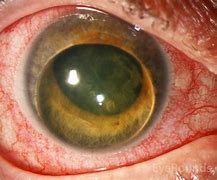 Image result for Displaced Cataract