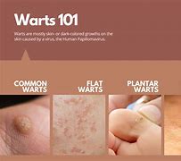 Image result for What Causes Filiform Warts