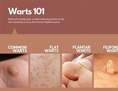 Image result for Water Warts Treatment