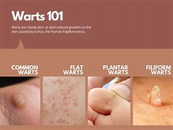 Image result for Common Wart Diagram