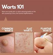 Image result for Venereal Warts Treatment
