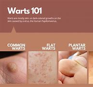 Image result for Causes of Genital Warts