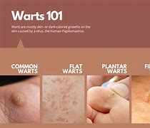 Image result for STD Warts