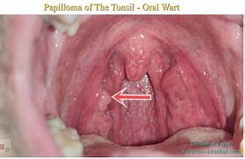 Image result for Papilloma On Tonsil