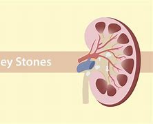 Image result for Cancer Kidney Stones