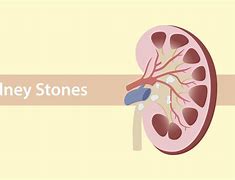 Image result for 2 Cm Kidney Stone