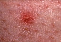 Image result for Red Blotches On Skin